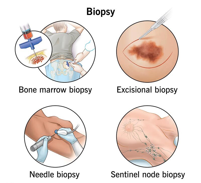 types of biopsy