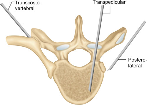 Biopsy of Spine