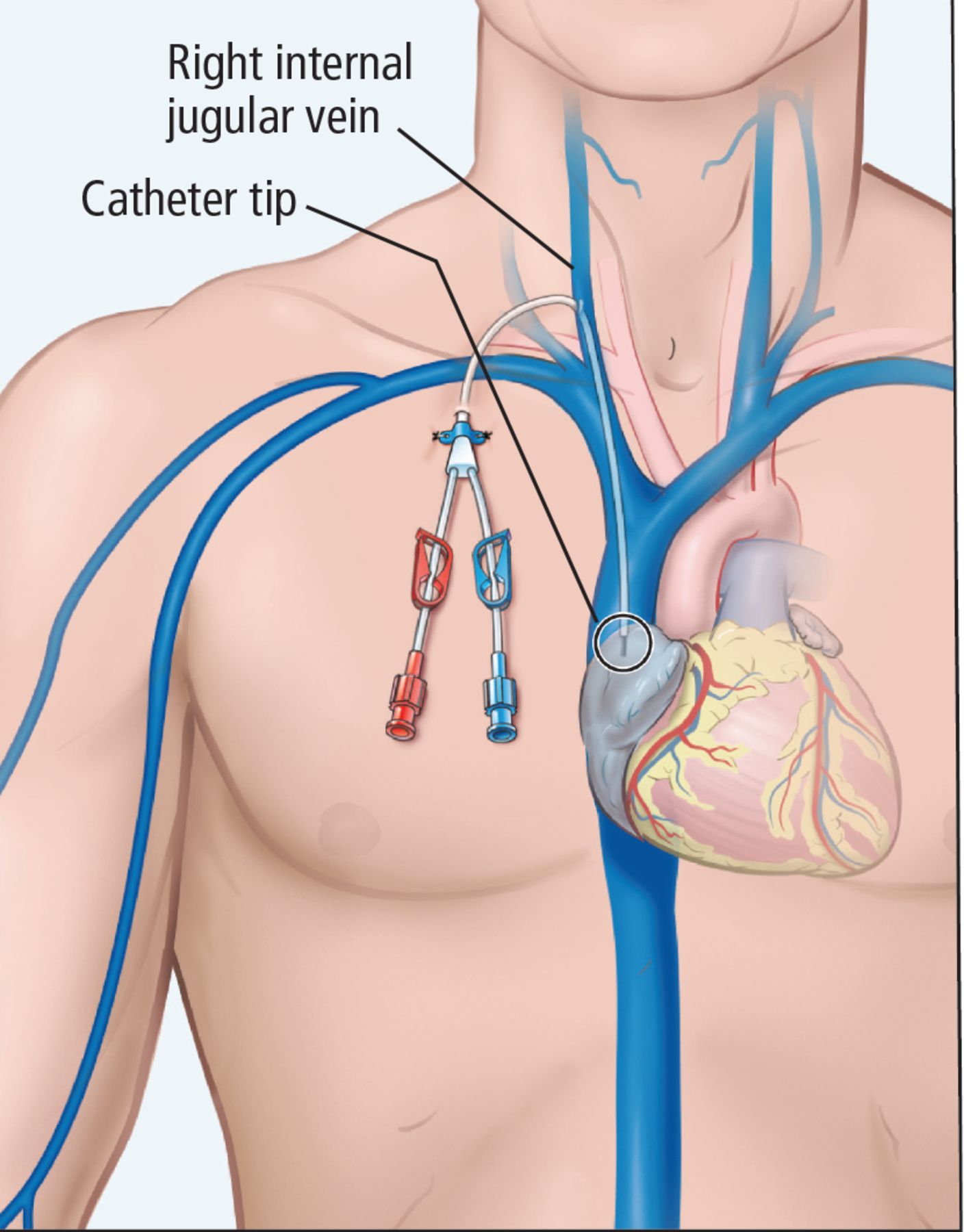 Picc line