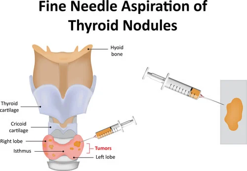 Fine Needle Aspiration