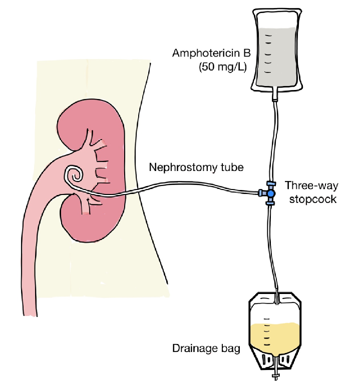 pcn for kidney