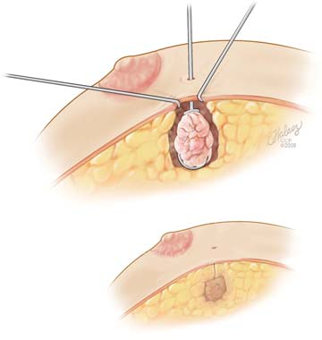 Wire Guided Lumpectomy