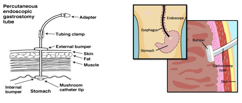 percutaneous endoscopic gastrostomy