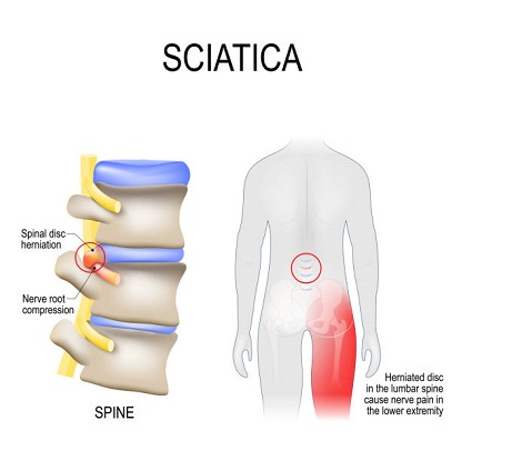 Sciatica nerve