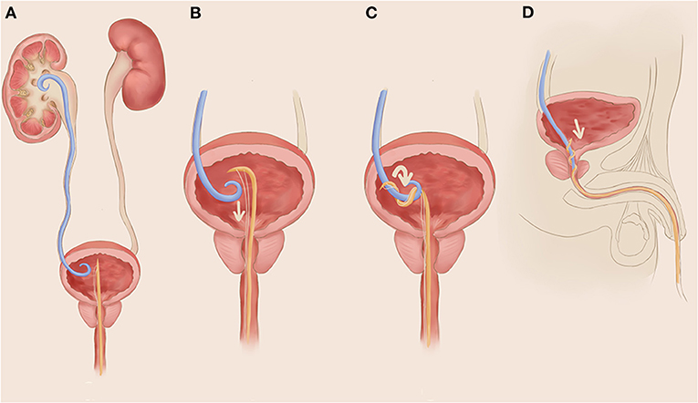 Best Doctor for DJ Stent in ureter