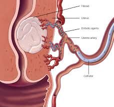 Uterine Artery Embolization