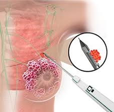 core needle biopsy