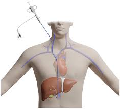 Liver Biopsy