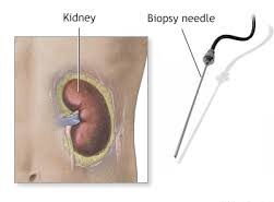 Kidney Biopsy