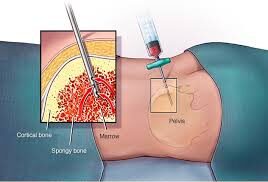 Bone Marrow Biopsy