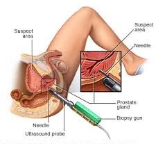 Prostate Biopsy