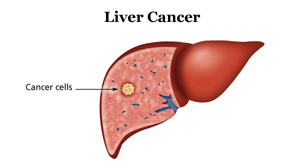 liver cancer