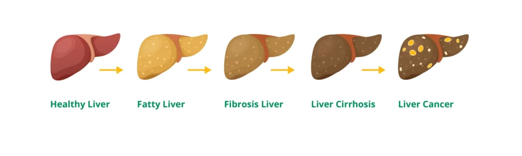 Liver cancer need Transarterial chemoembolization