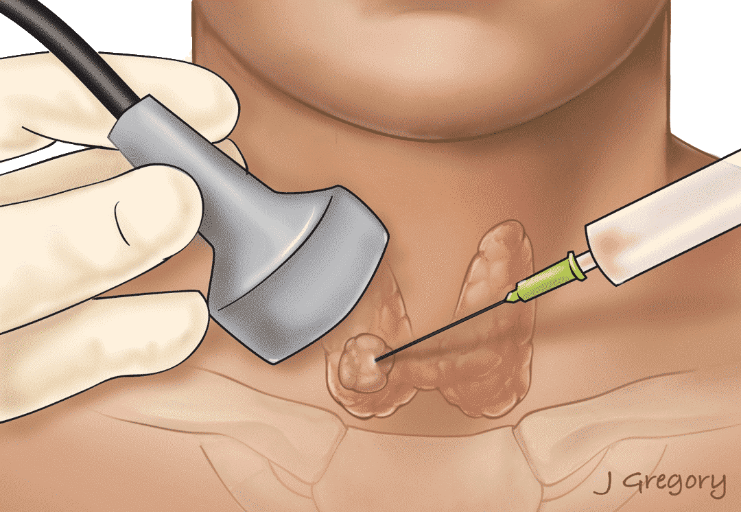 Thyroid Biopsy