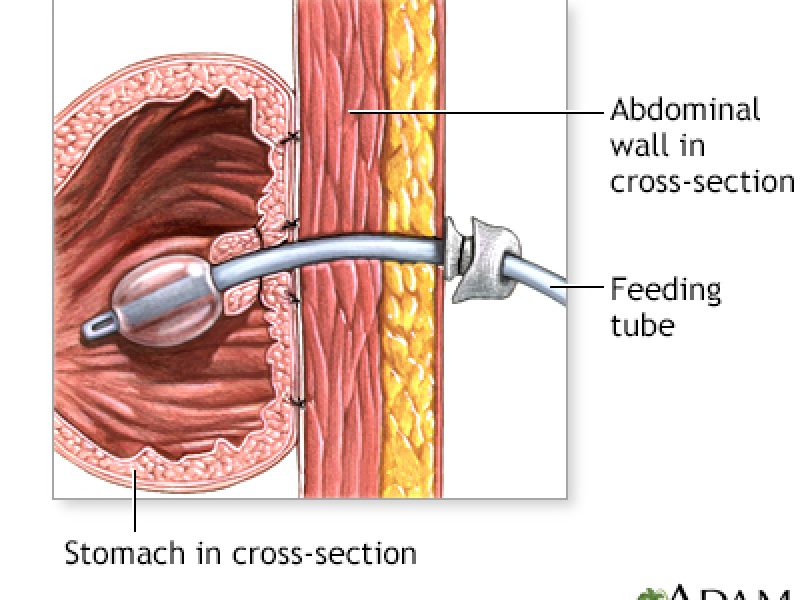 Percutaneous Endoscopic Gastrostomy