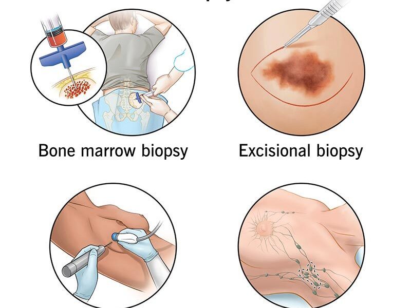 types of biopsy