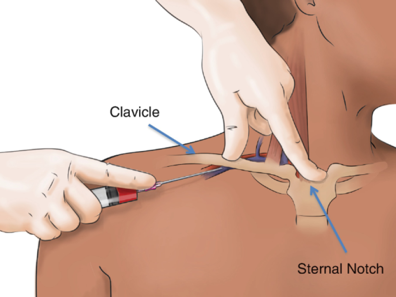 Central lines insertion