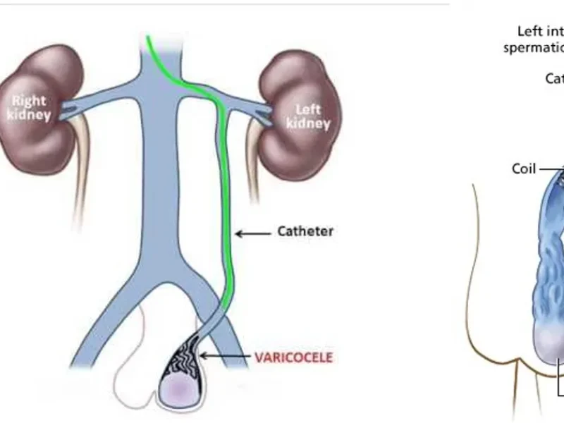 Diagram-showing-varicocele-embolisation-from-neck-vein