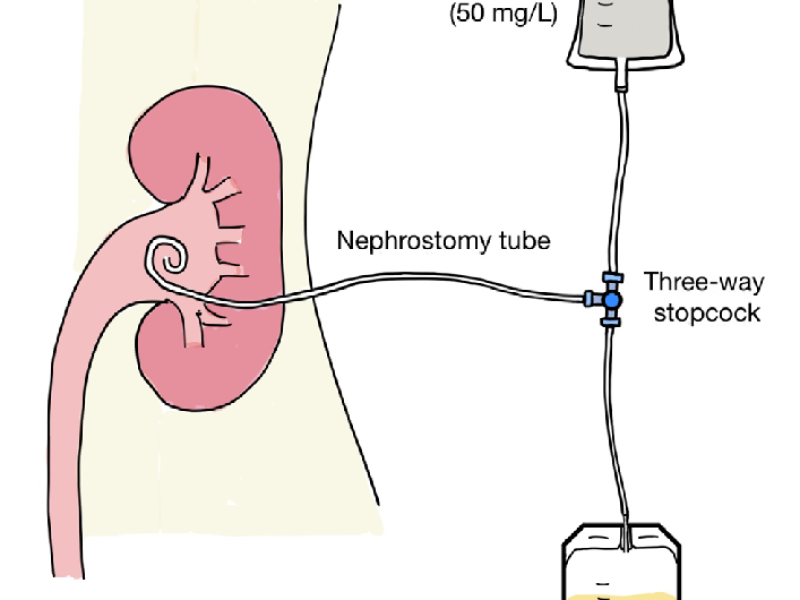 pcn for kidney