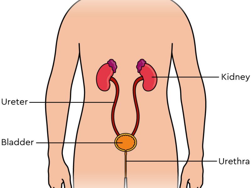 DJ Stent in Kidney