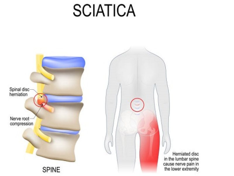 Sciatica nerve