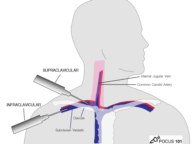 Central lines insertion