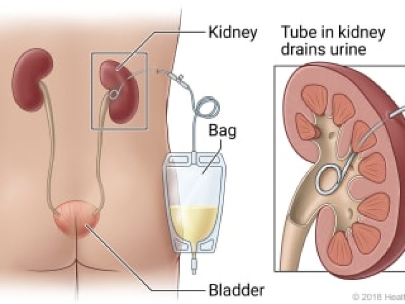 Percutaneous Nephrostomy