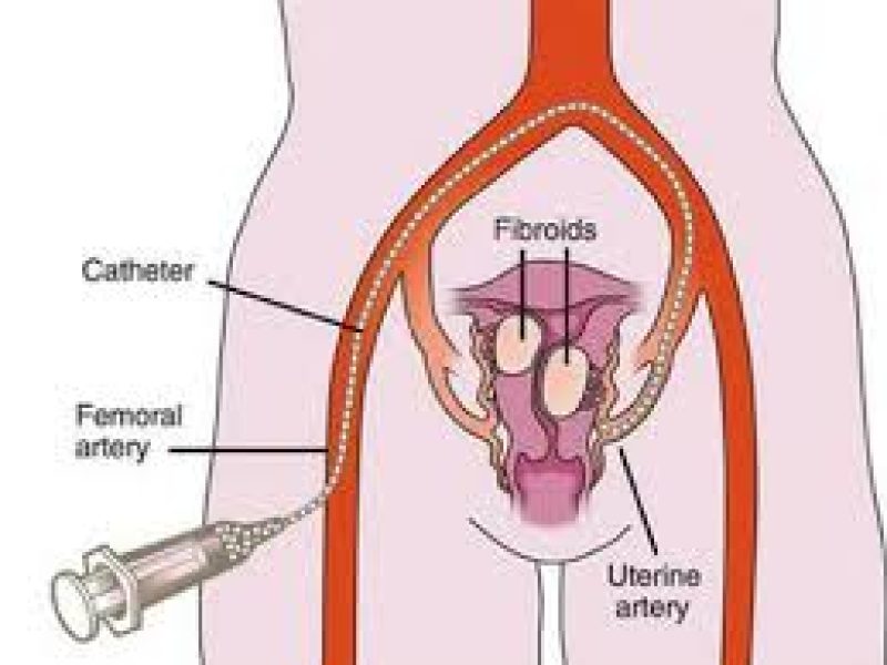 uterine fibroid embolization