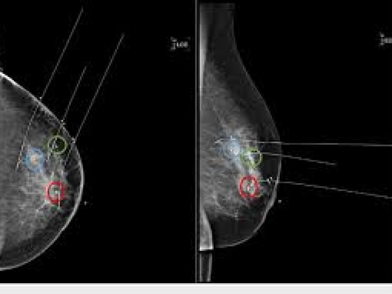 Breast Cancer Wire Localization