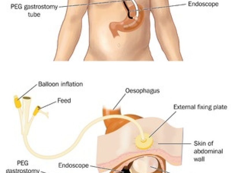 Percutaneous Endoscopic Gastrostomy